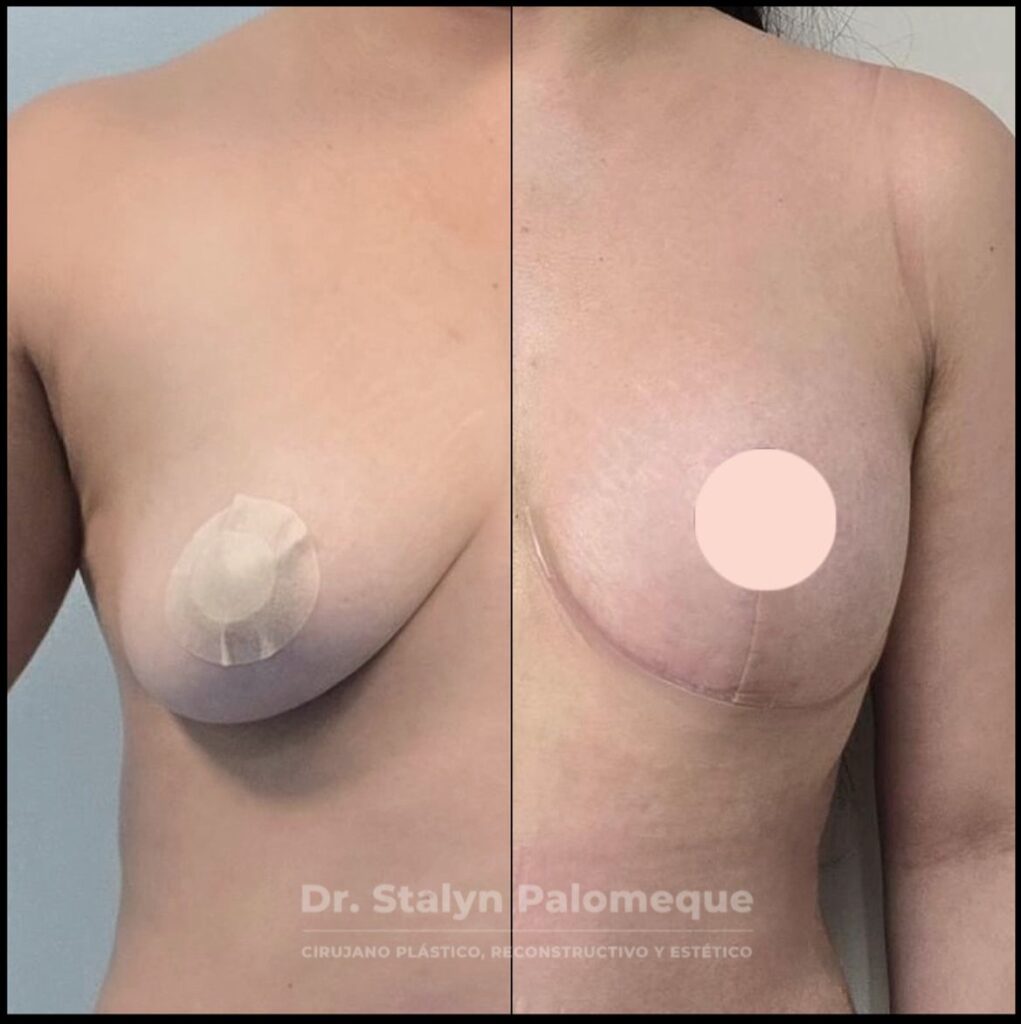 mamoplastia_1