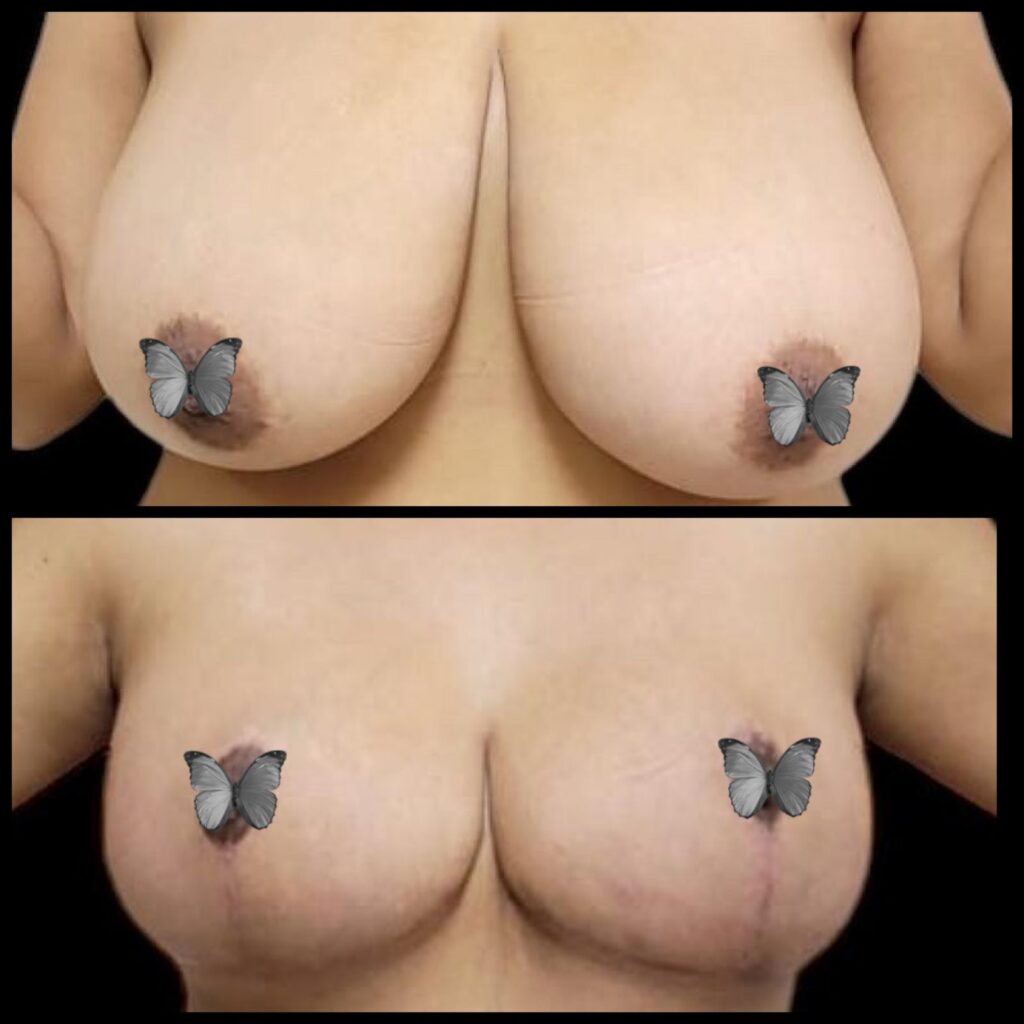 mamoplastia_10