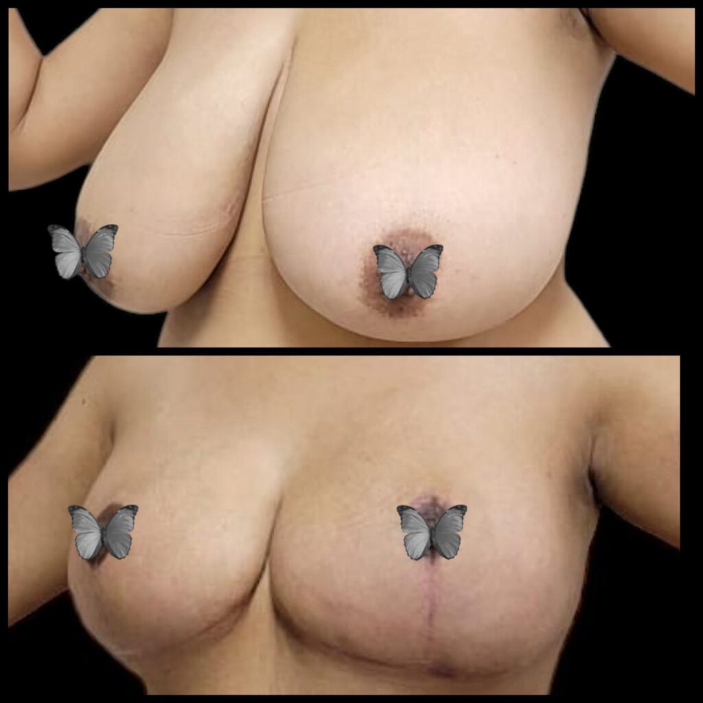 mamoplastia_17