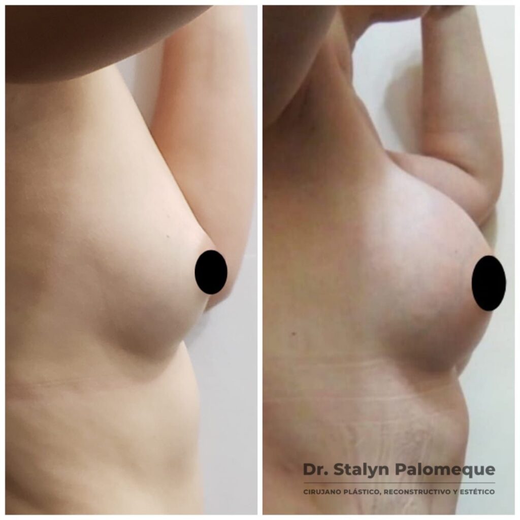 mamoplastia_2