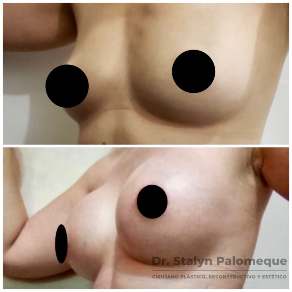mamoplastia_3