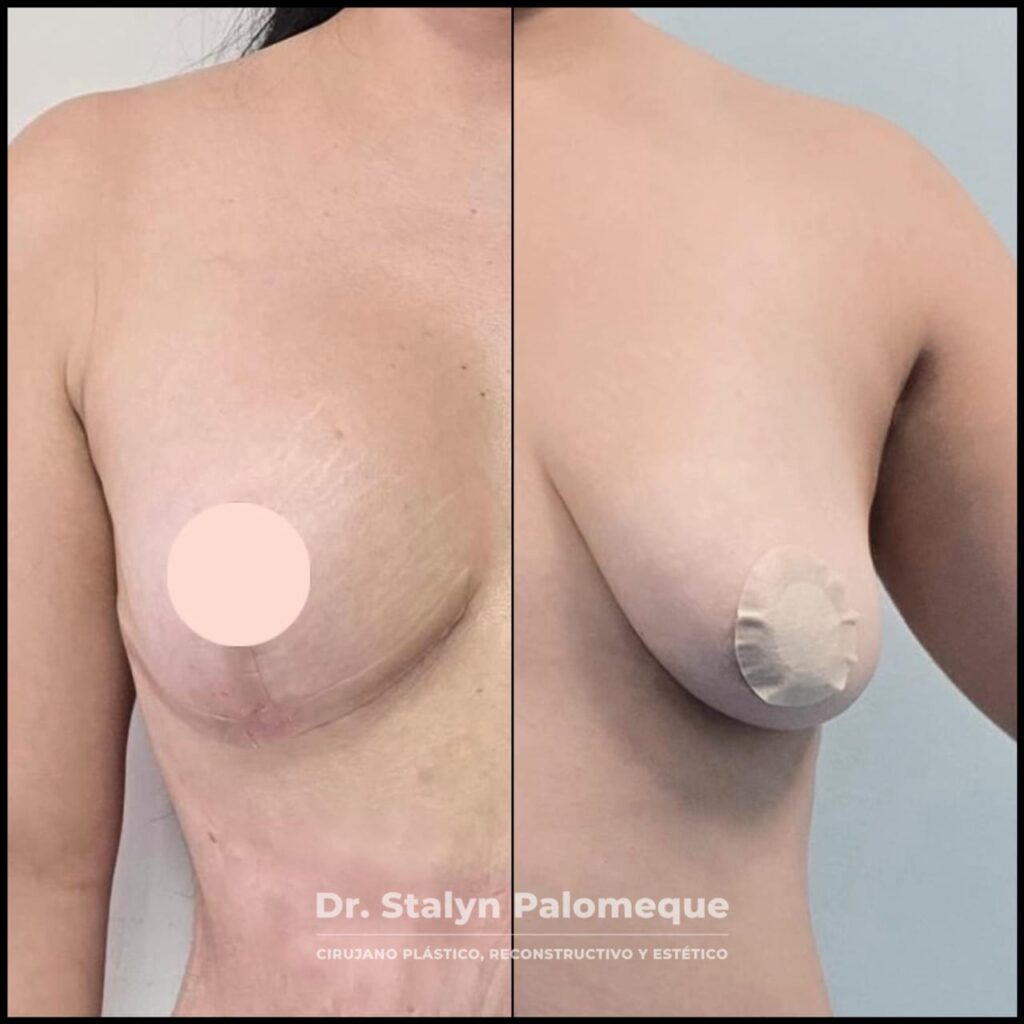 mamoplastia_4