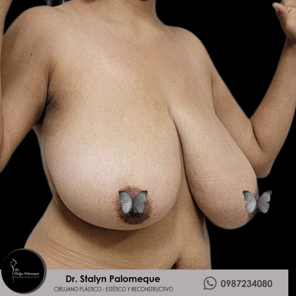 mamoplastia_5