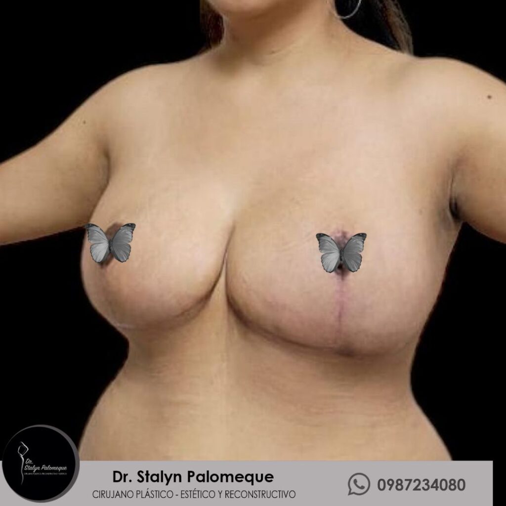 mamoplastia_7