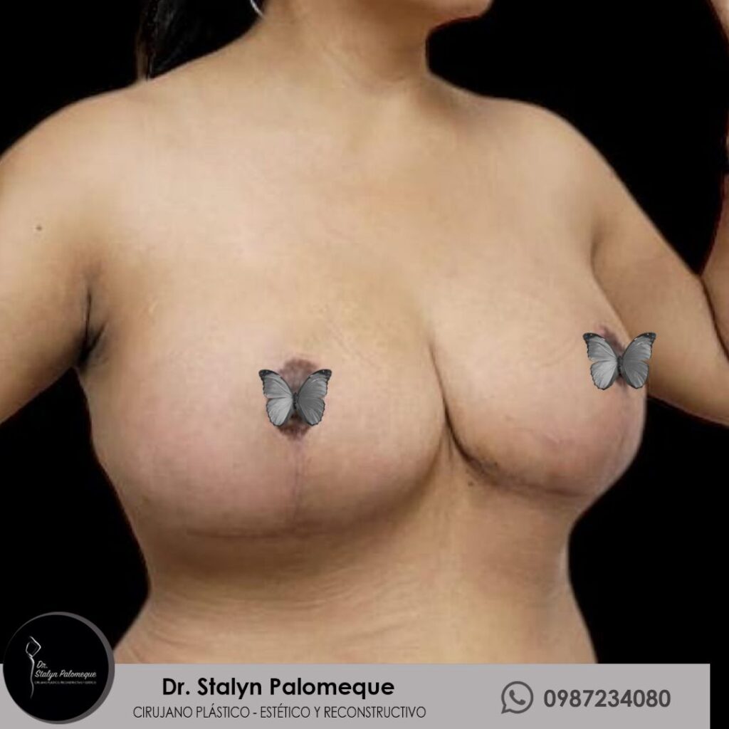 mamoplastia_8